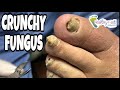 CRUNCHY FUNGAL NAILS...IT TOOK 2 PEOPLE TO CUT THE TOENAILS!