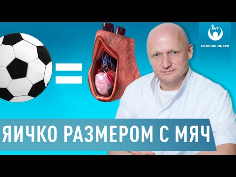 Гидроцеле. Водянка яичка. Яичко размером с футбольный мяч.| Случай из практики хирурга Шевцова