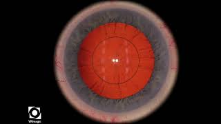 EyeSi CAT D Capsulorhexis Errant Tear CCW, High Tension