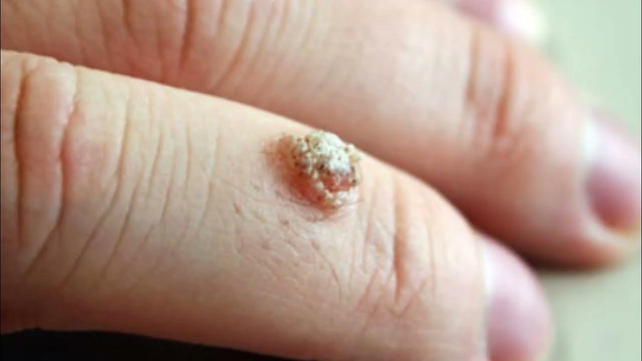 PLANTAR WART REMOVAL VINEGAR Is Vinegar Effective for Wart Removal