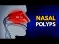 NASAL POLYPS, Causes, SIgns and Symptoms, Diagnosis and Treatment.