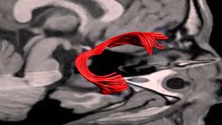 Ceci n'est pas une Uncinate fasciculus