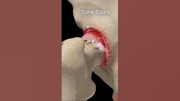 #osteoarthritis #msn#disease #trending