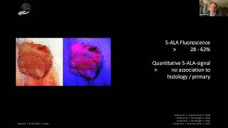 EANS WEBINAR: BRAIN METASTASES