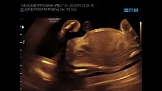 Med2000Eco Ipoplasia Toracica