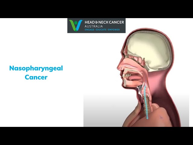 nasopharyngeal carcinoma symptoms