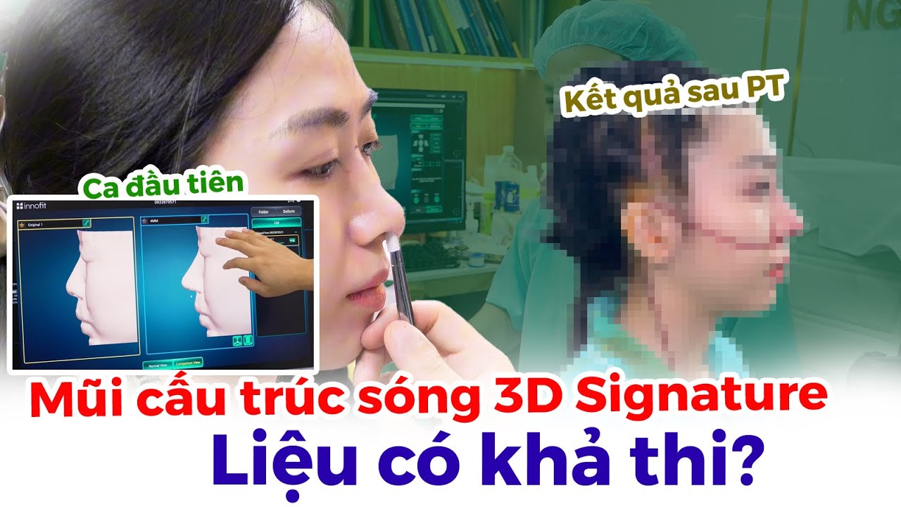 Nâng Mũi 3D Signature Liệu Có Khả Thi Cho Mũi Cấu Trúc Phức Tạp 