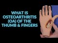 What is Osteoarthritis (OA) of the Thumb & Fingers?