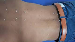 Imrx Acupuncture Moxibustion And Electrical Needle Stimulation Dr.shashikant Style Therapy