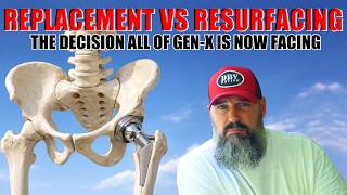 All Things GenX: Hip Replacement Vs. Hip Resurfacing, The GenX Guide Nobody Gave Us