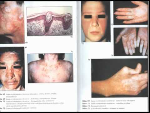 Derma predavanje br5 bolesti vezivnog tkivaSLE,sklerodermija,dermatomiozitis