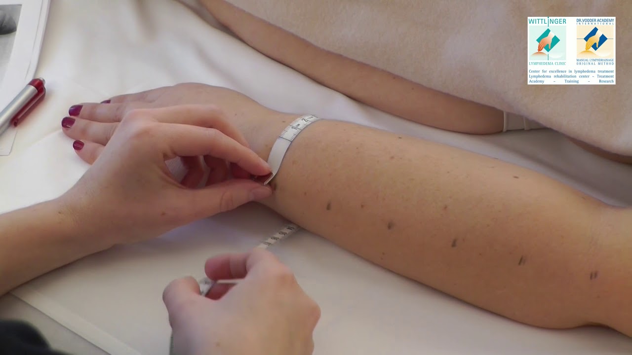 volume measurement of an armlymphedema patient