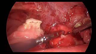 Pelvic Appendix Hidden by Ileus | Safe Laparoscopic Appendectomy