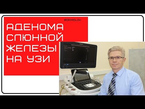 Видео: Может ли плеоморфная аденома стать злокачественной?