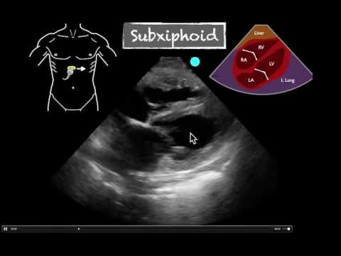 Image of POCUS Cardiac Subxiphoid Severely Reduced EF
