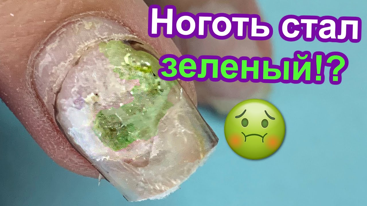 Позеленел Ноготь под Покрытием ?? Это что, плесень? ?? Или грибок?? Как ...