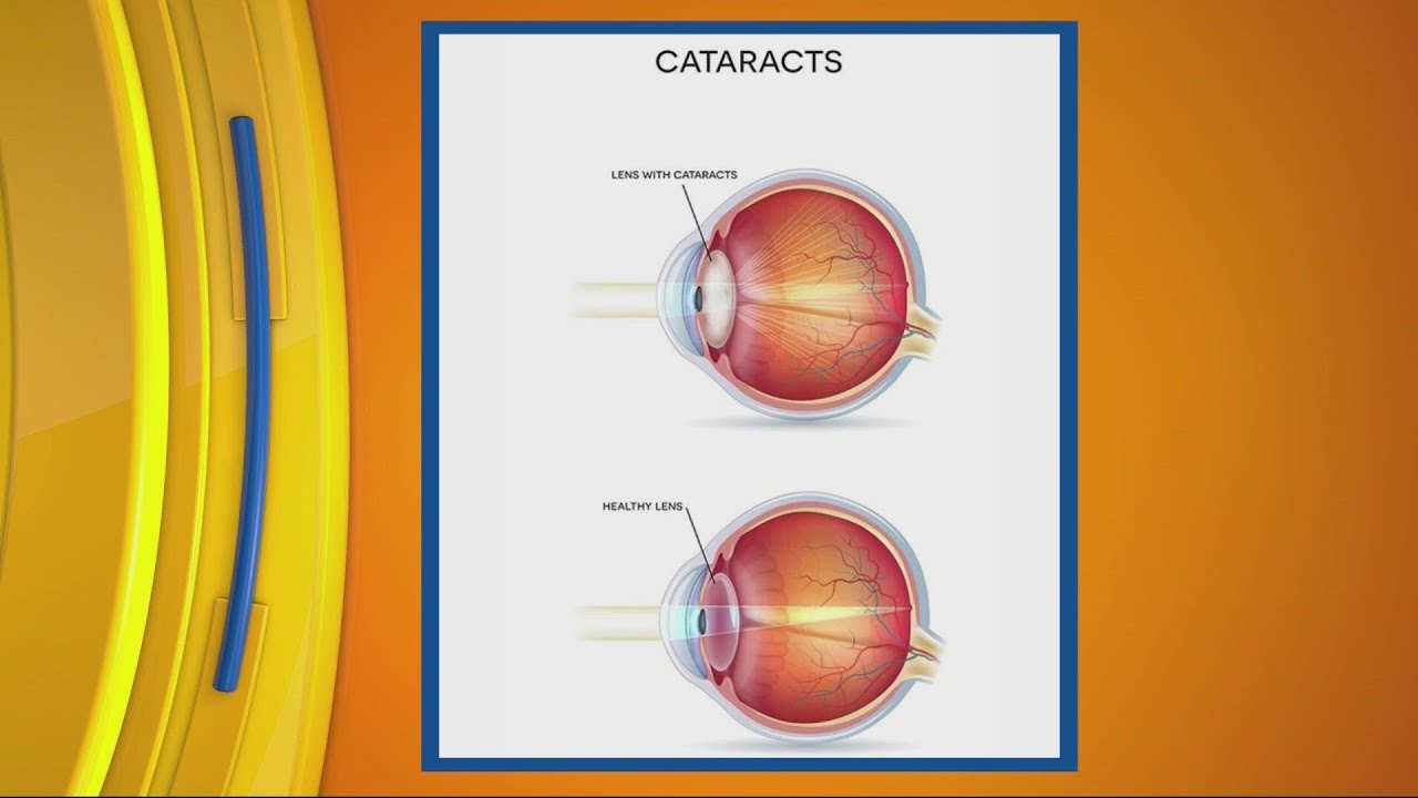 Chittick Eye Care with Dr. Sola, Ophthalmologist ciLiving YouTube
