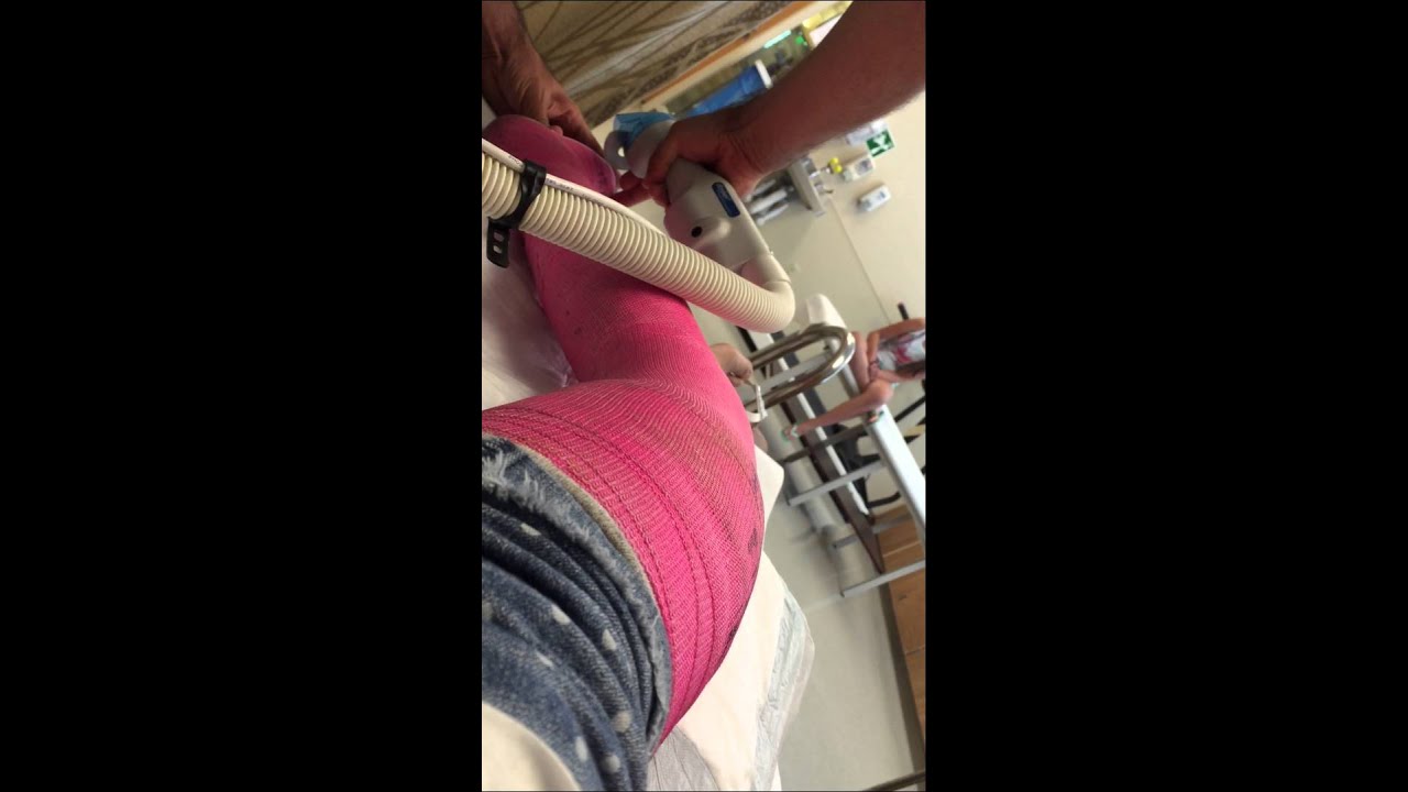 Cast Removal Femur Fracture Youtube