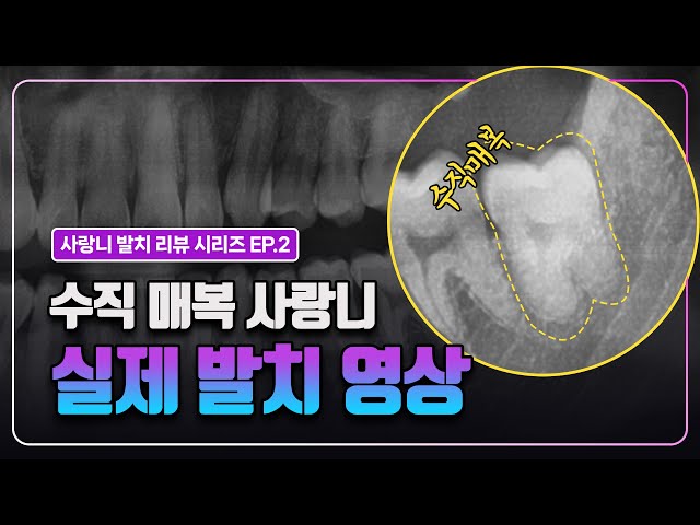 수직매복 사랑니, 발치 과정 보여드릴게요.(20대 남성) #실제발치영상