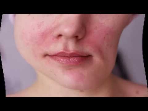 Как избавиться от покраснение кожи лица