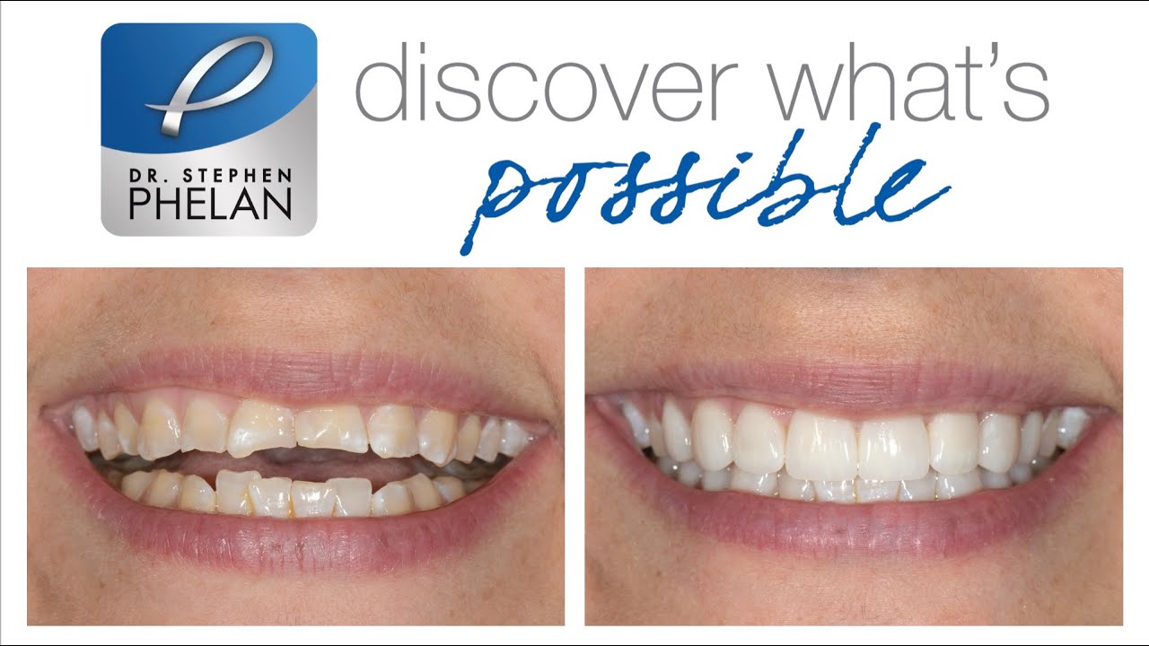 Full mouth rehabilitation for advanced tooth wear and erosion case