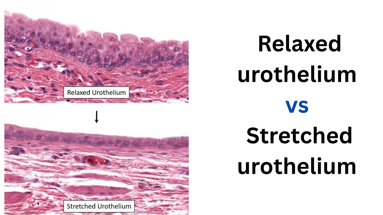 Transitional Epithelium I: What Happens to Your Bladder Wall When It's ...