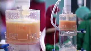 Q-Graft, a fully closed system to process SVF from fat.