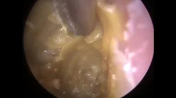 884 - Severely Swollen Outer Ear Infection Suction
