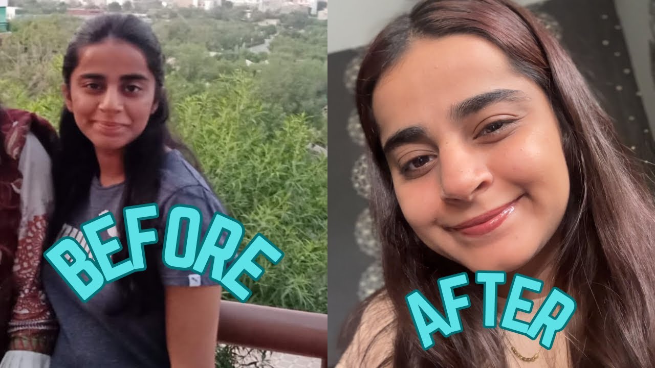 My Real Skin Journey| Dealing with Hyperpigmentation, Suntan & Texture | Honest Transformation