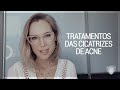 Tratamantos das cicatrizes de acne - Dra. Gabriela Schaefer - Dermatologista