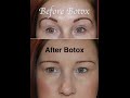 Botox Gone Wrong! - Before & After - My Story