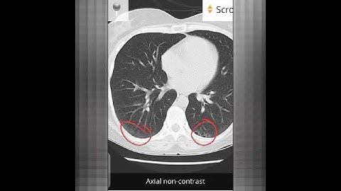 ct chest (NSIP)