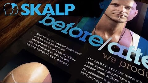 Scalp Micropigmentation Testimonials by Skalp®