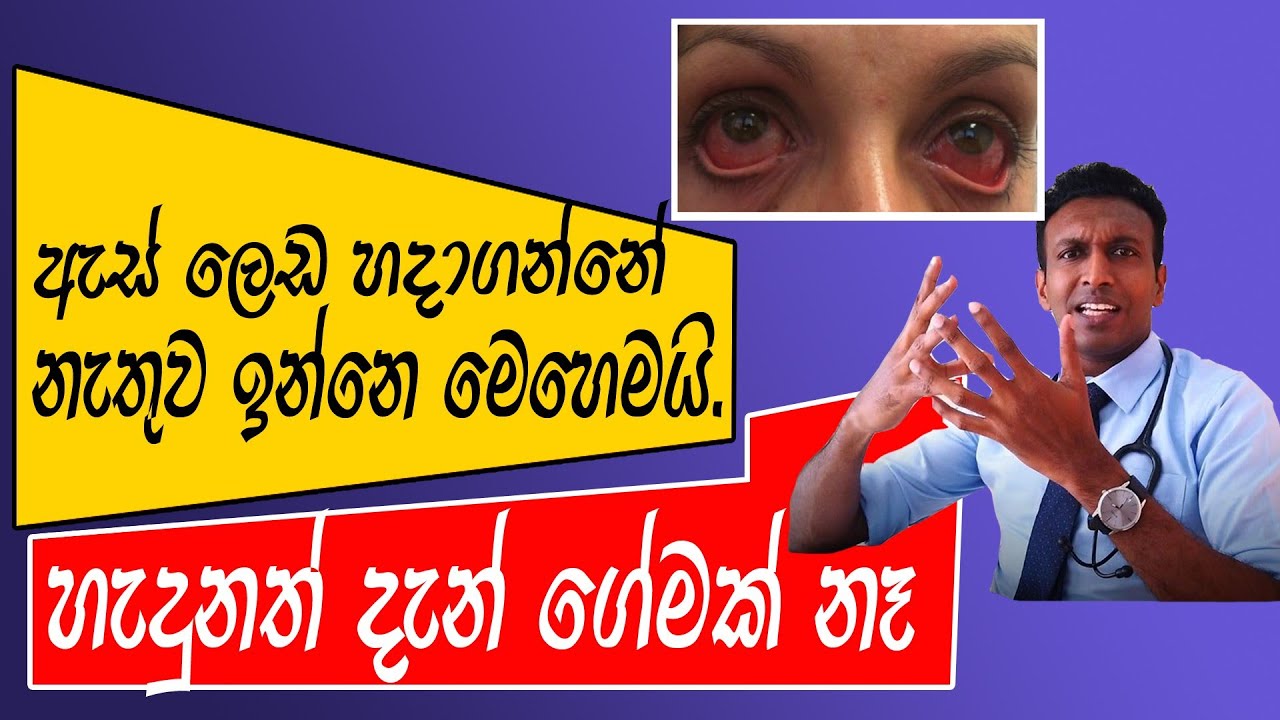 ඇස් ලෙඩ හදාගන්නේ නැතුව ඉන්නෙ මෙහෙමයි. හැදුනත් දැන් ගේමක් නෑ. Everything about Conjunctivitis