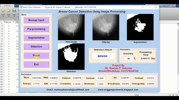 Breast Cancer Detection Using Machine Learning Matlab Source Code | Breast Cancer Classification