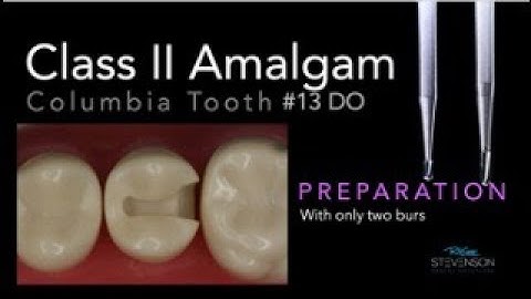 Class II Amalgam Preparation Columbia #13 DO - Two Burs Only