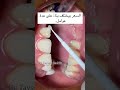 سعر تقويم الاسنان