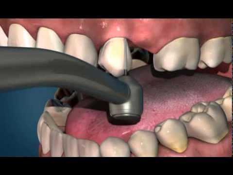 штамповано-паяный мостовидный протез. зубные мосты видео. зубные мосты видео. керамокомпозитный протез. зубные мосты видео.