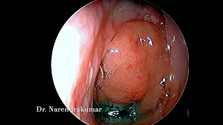 Endoscopic Adenoidectomy using Microdebrider- Dr. V. Narendrakumar