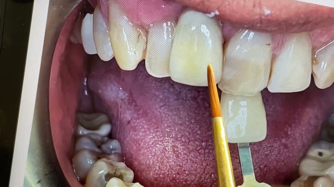 Implant #8 Patient Photo Match Initial Porcelain