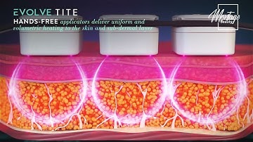 Body Contouring in Montage Beauty/ EvolveX Tite, Tone, Transform