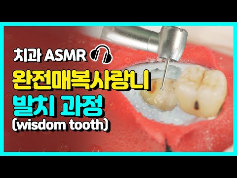 Here&rsquo;s The Full Wisdom Tooth Removal Process｜High Class Dentist ASMR｜While You&rsquo;re Saying Ahh~