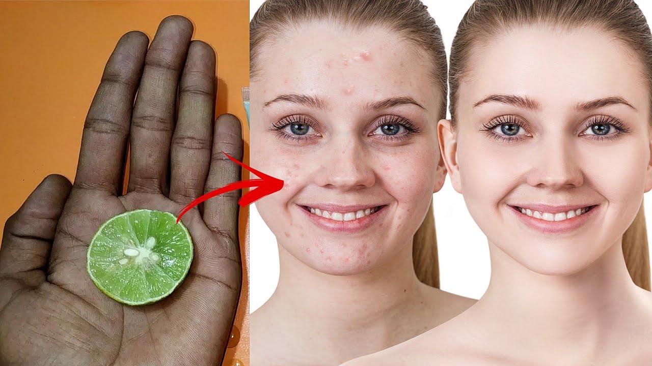 एक बार में पिंपल्स हमेशा के लिए खत्म हो जाएगा | pimples removal at home in hindi - YouTube