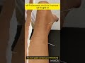 #heels #pain #acupuncture #health #jointpain #muscle #spine #holistichealth #doctor #indore