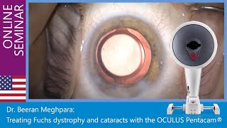 Dr. Beeran Meghpara: Treating Fuchs dystrophy and cataracts with the OCULUS Pentacam®