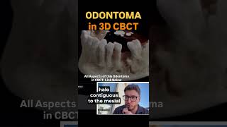 Odontoma: All Characteristics in a 3D reconstruction of CBCT #dentalexam