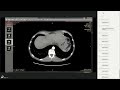 КТ живота для начинающих   диагностика заболеваний поджелудочной железы
