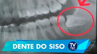 Coágulo siso estourou dentes do