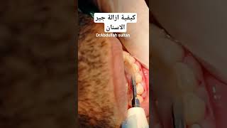 كيفية ازالة جير الاسنان||remove dental tartar ||dental scaling #dr_abdullah_sultan_dentist #dentist