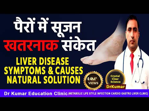 पैरों में सूजन खतरनाक संकेत/Liver disease symptoms and causes/ Natural solution / Dr Kumar education